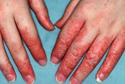 Инфекционные болезни кожи у детей и взрослых